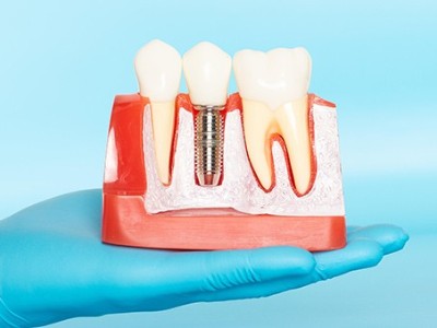 種牙VS鑲牙，你適合哪種?