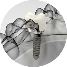 術(shù)前研究、模擬提升種植成功率