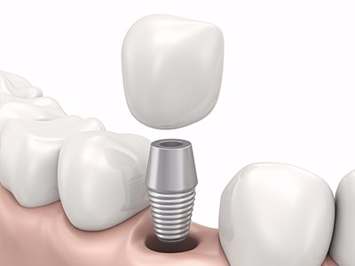 在承德哪家口腔醫(yī)院口腔種植齒好一點，惟德口腔醫(yī)院值得您的選擇