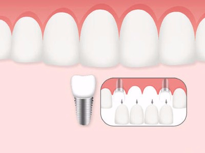 惟德口腔口腔種植怎么樣？惟德口腔就來為您一一解答