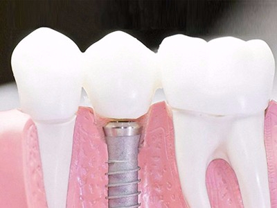 在承德口腔種植齒需要多少錢？惟德口腔一一為您道來